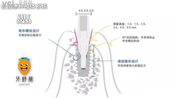 韩国仕诺康和奥齿泰哪个好？看完对比再做种植牙也不迟！.jpg