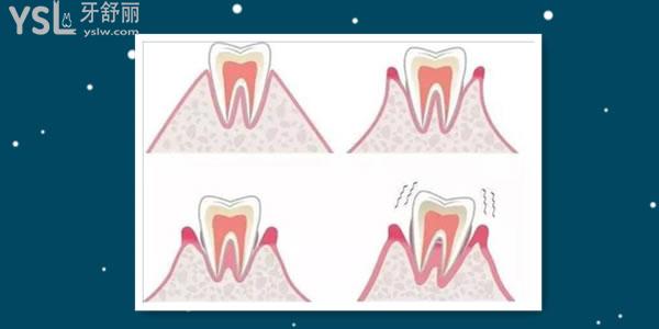 牙龈萎缩是什么原因导致的 能么.jpg