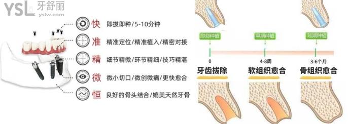 即刻种植早期种植延期种植的优缺点