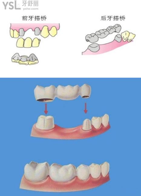 牙齿搭桥图片图片