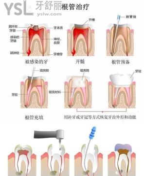 牙烂到什么程度要根管治疗