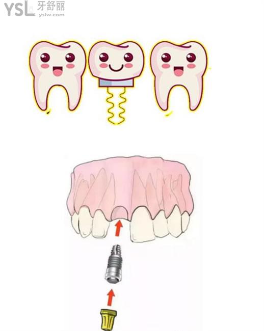 卡通种植牙图片