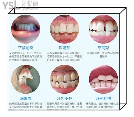 儿童牙齿矫正硅胶牙套品牌有哪些 改如何选择呢.jpg