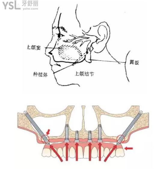 穿颧骨种植牙示意图图片