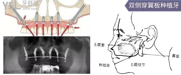 穿翼种植牙示意图图片