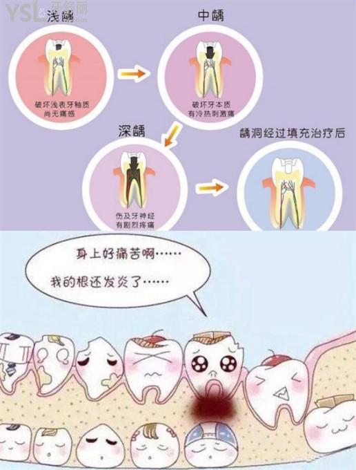 兒童齲齒怎麼治療比較好治療費用是多少不懂的看過來吧