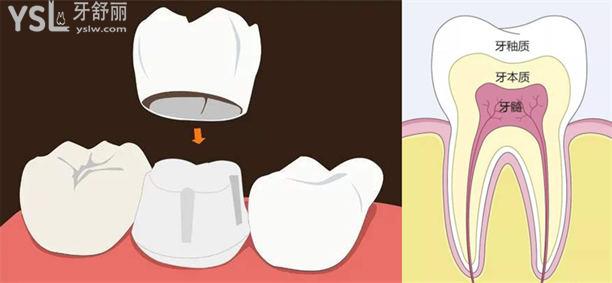 东莞烤瓷全瓷牙冠大概多少钱一颗