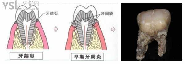 牙周袋变深