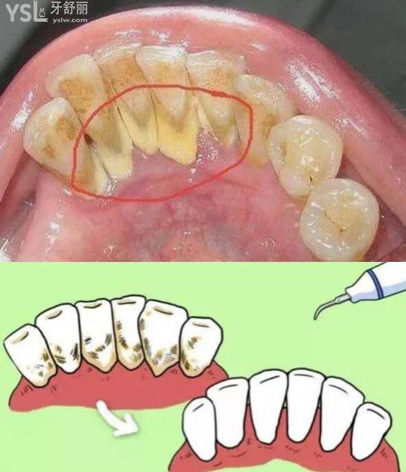 牙结石在哪个位置图片图片