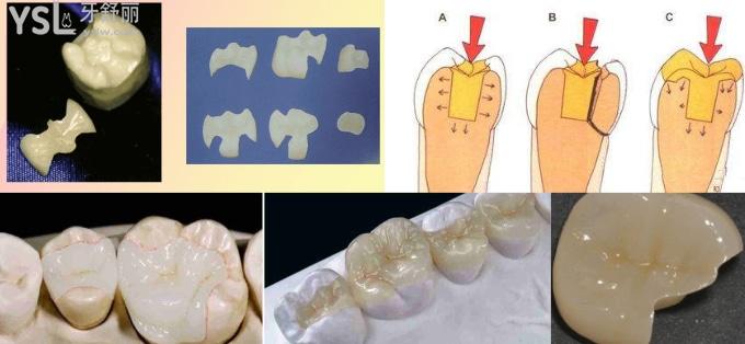 嵌体为什么比牙冠贵牙齿做嵌体和牙冠有什么区别呢