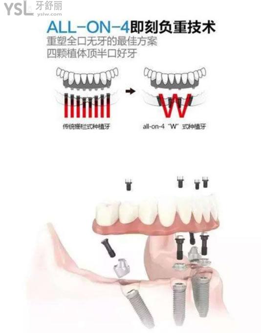 all-on-4半口即刻负重种植技术