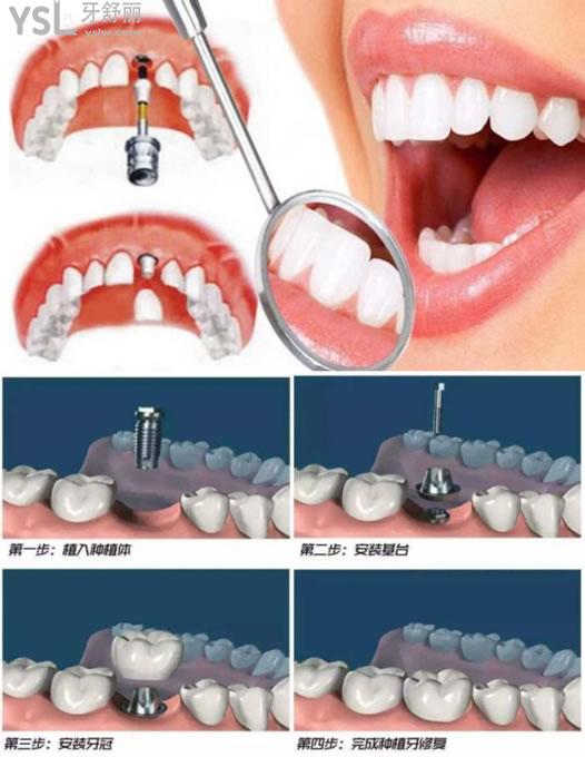 种植牙选择