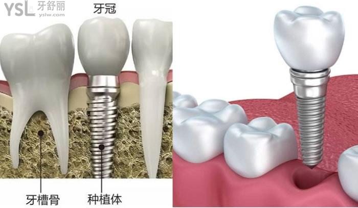 韶关矫正牙齿价格多少