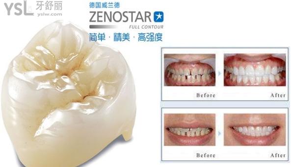 威兰德臻瓷2400贵不贵，威兰德臻瓷官方价格