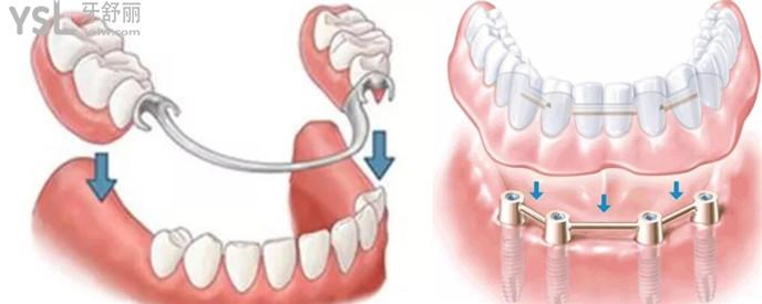 做半固定种植牙的好处和坏处