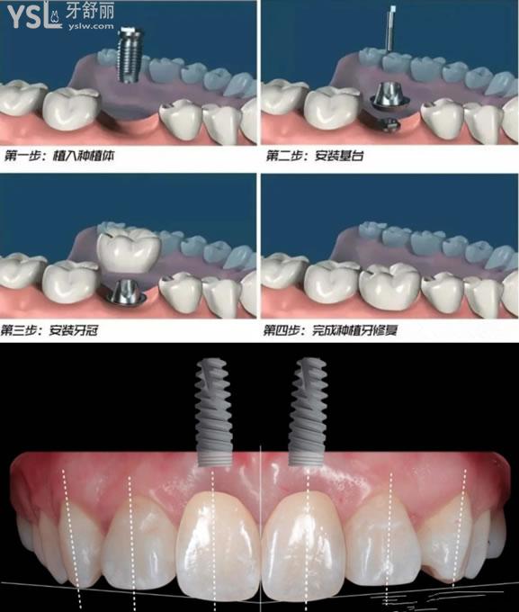 河源恒信口腔种植牙过程图