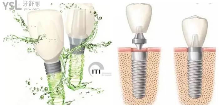 瑞士种植牙品牌不止iti 瑞士品牌排行盘点