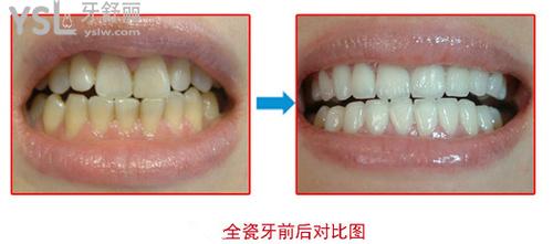 全瓷牙的危害有哪些，全瓷牙品牌应该怎么选，全瓷牙多少钱