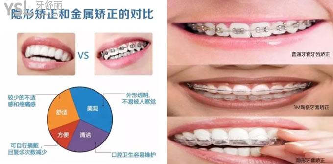 牙齿矫正对比