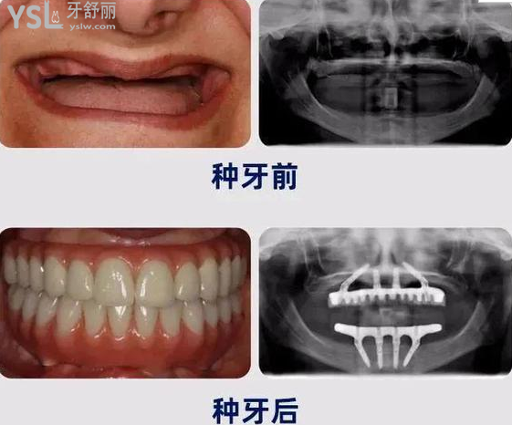 请把这条大数据推给缺牙的人，福州维乐口腔医院帮助缺牙人士重拾口福！