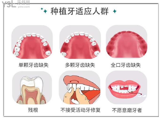 种植牙适应人群