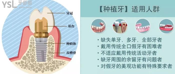 无锡种植牙多少钱一颗