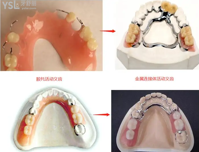 活动义齿材质种类