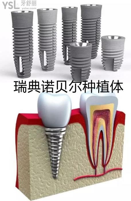 鄒城市口腔醫院種植牙收費標準,揭秘種牙項目1顆價格要多少_