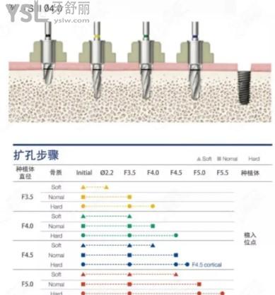 韩国奥齿泰种植体