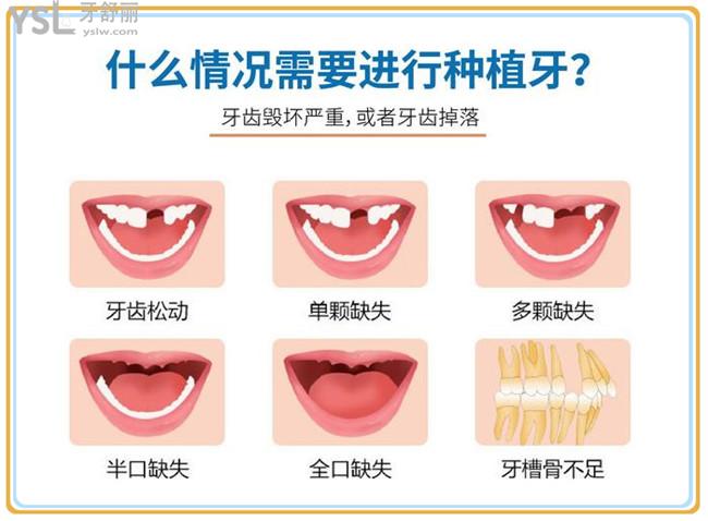 什么情况需要种植