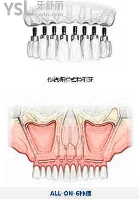 半口6颗种植牙图片大全，全口半口种植牙价格