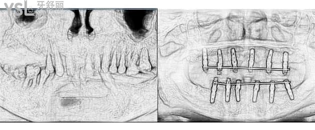 半口6颗种植牙图片大全，全口半口种植牙价格