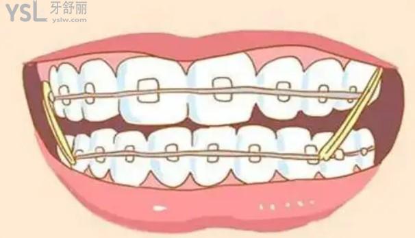 正畸带橡皮圈卡通图