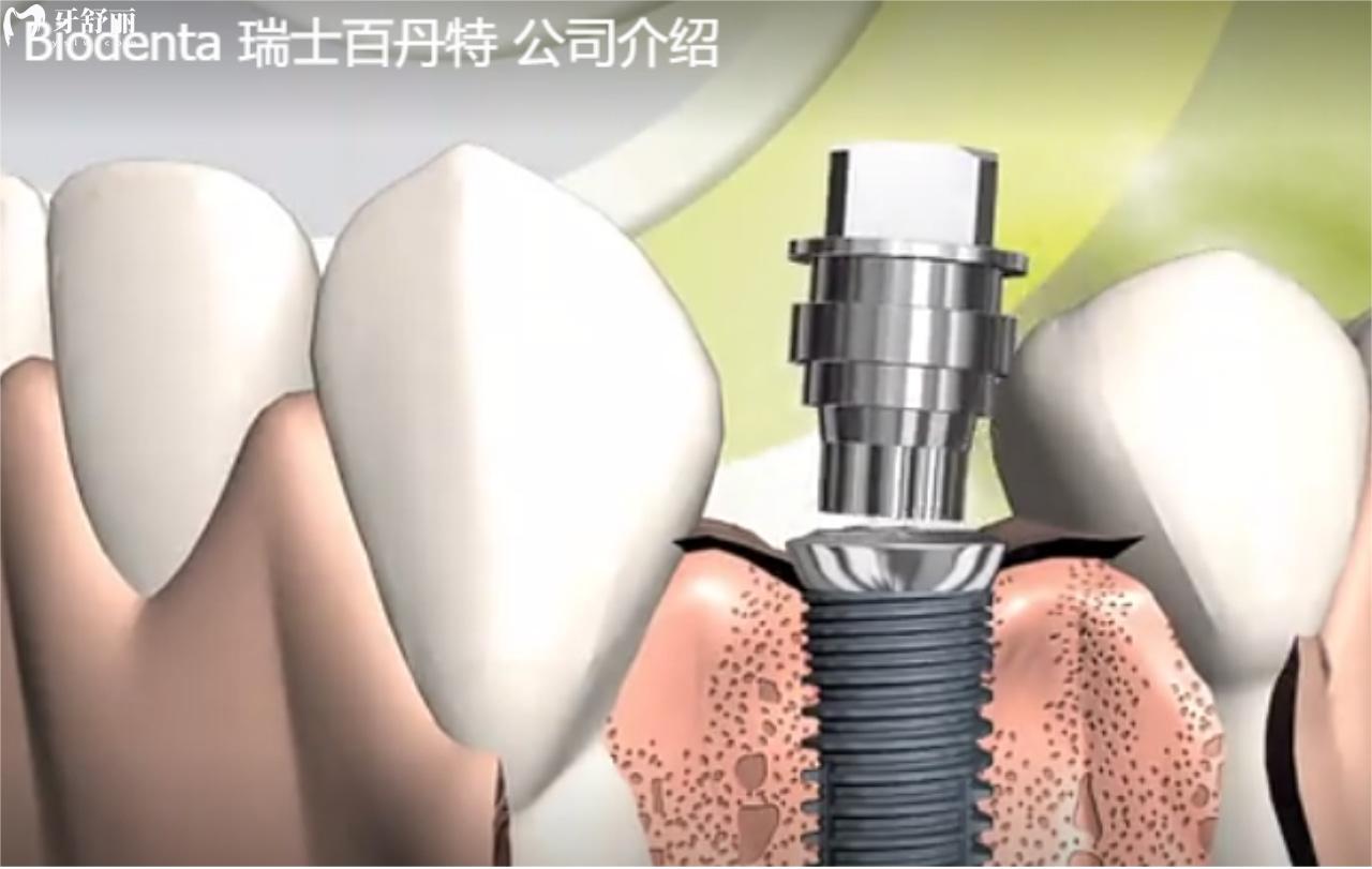 瑞士百丹特种植牙是纯钛的吗?性能如何?使用寿命多久?