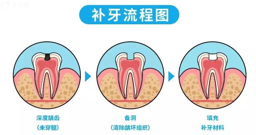 补牙流程图