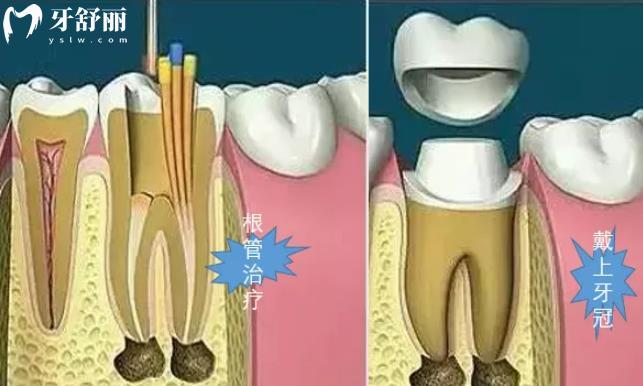 根管治疗