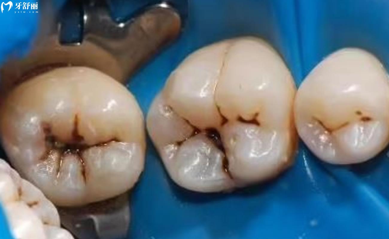 虫牙是牙齿的虫子吗图片