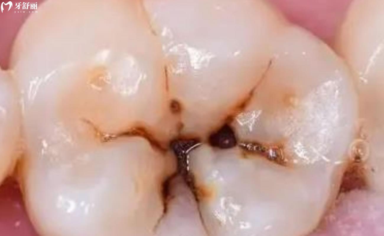 蛀牙的表现特征是什么?