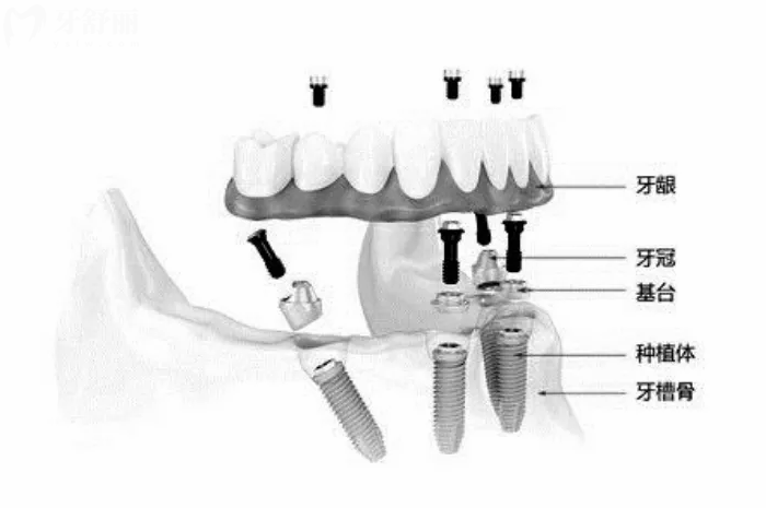 all-on-4种植牙