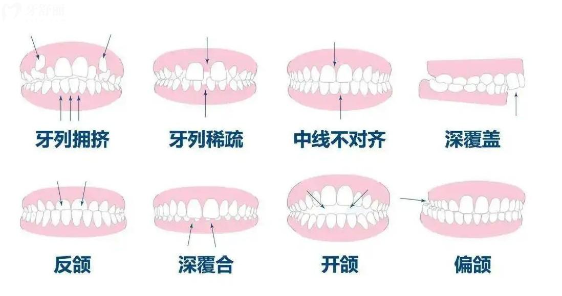 牙齿畸形