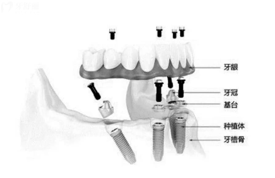 种植牙结构图
