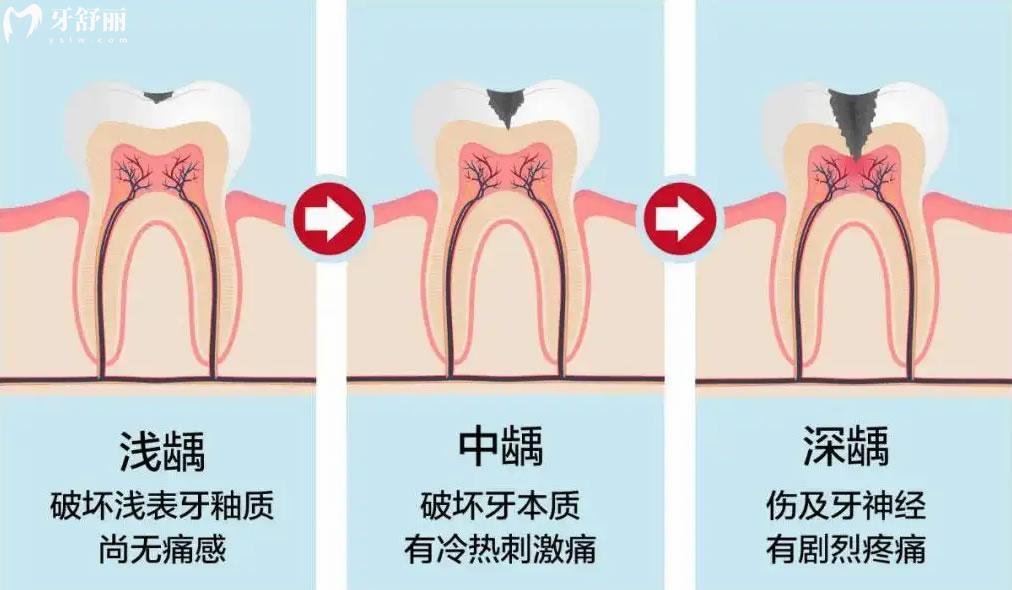 龋齿是由什么原因形成的,有什么危害呢?