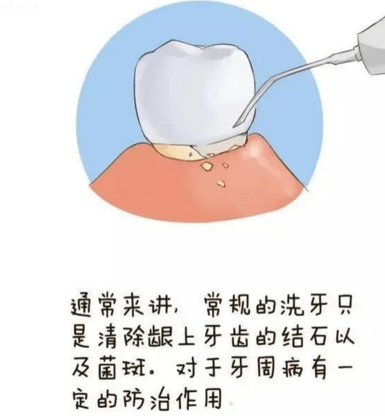 洗牙的作用