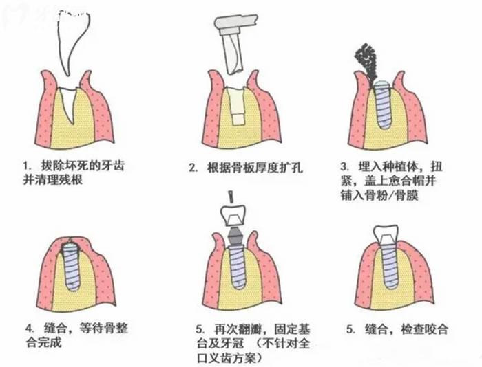 种牙过程