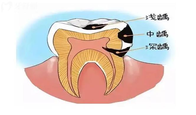 龋齿是怎么形成的