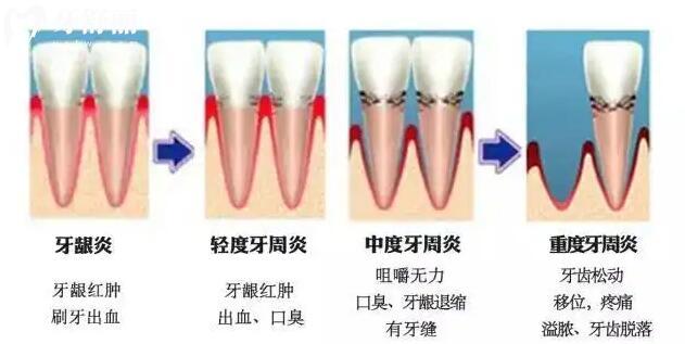 牙周炎能治好吗？