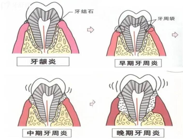 为什么会掉牙图片