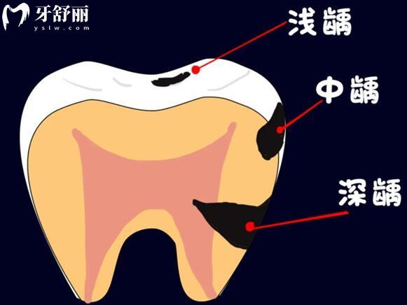 牙齿上面有黑线是什么原因造成的?该怎么治疗？.jpg