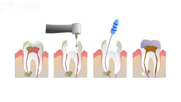 根管治疗