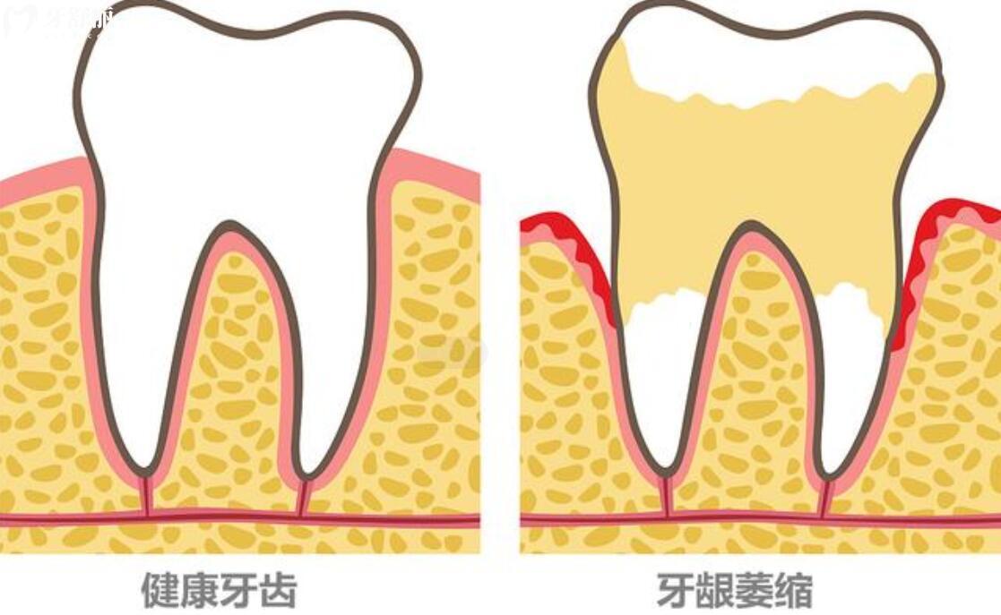 人的牙齒到什麼年齡開始鬆動